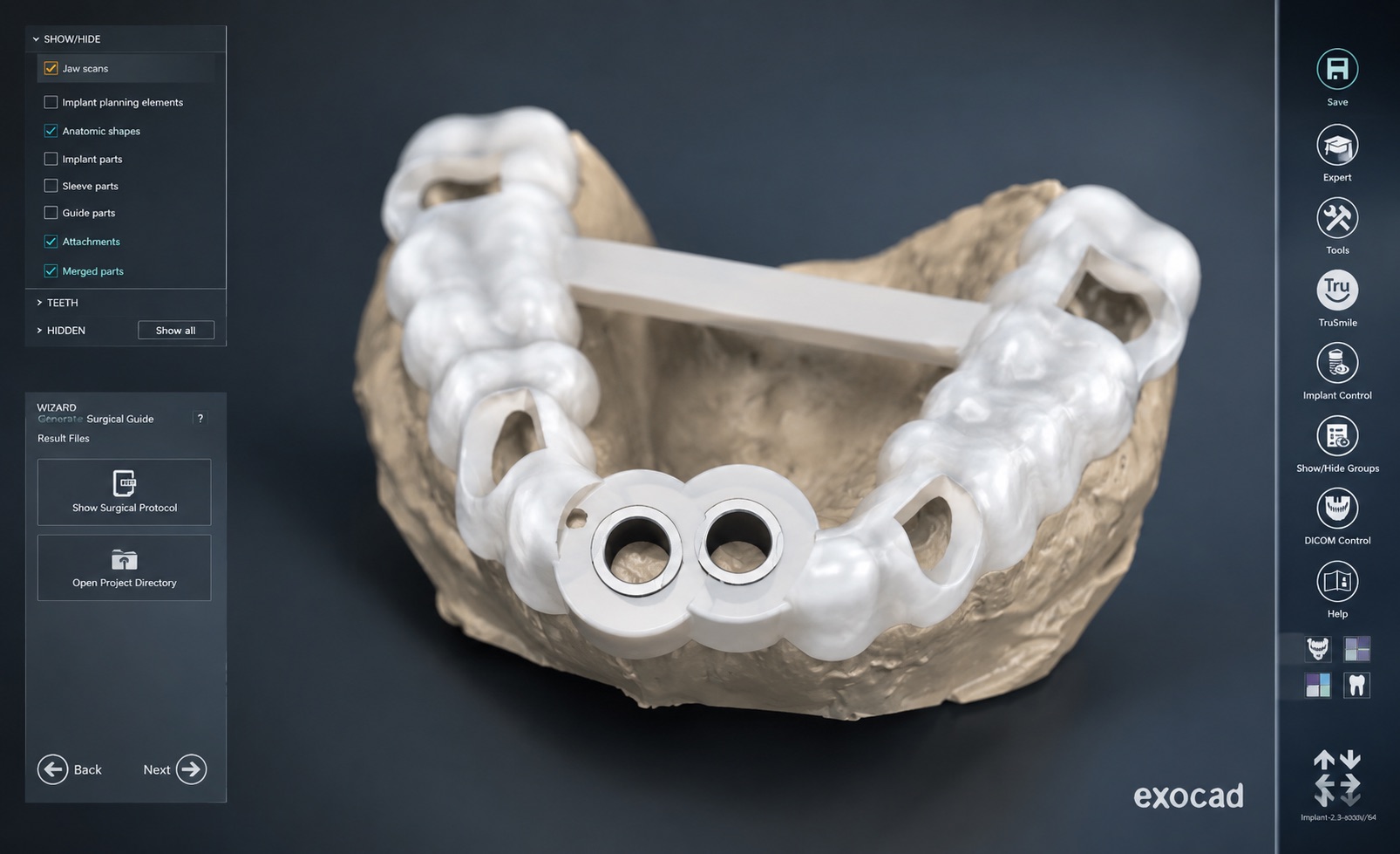 Flux numérique CAD/CAM logiciel Exocad — laboratoire Eurosmile, Paris 20e