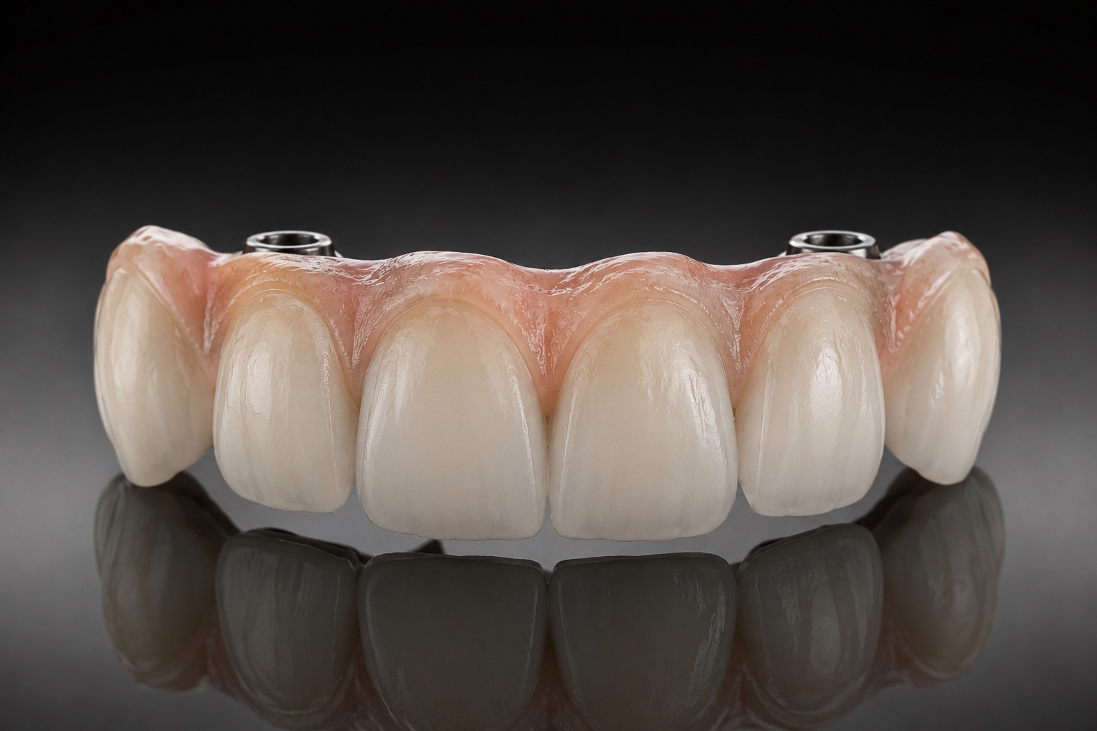 Prothèse fixe sur implant zircone — laboratoire Eurosmile, Paris 20e